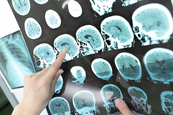 Les partenariats public-privés sont l’avenir de la recherche en neurosciences