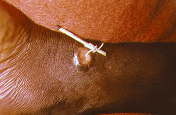 Londres double la mise contre les maladies tropicales