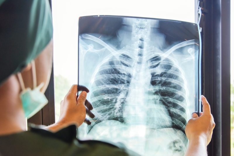 La Covid-19 et la guerre en Ukraine annulent les progrès dans la lutte contre la tuberculose