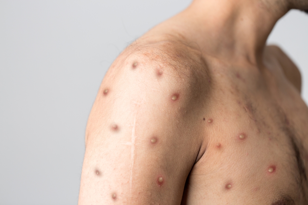 Monkeypox,New,Disease,Dangerous,Over,The,World.