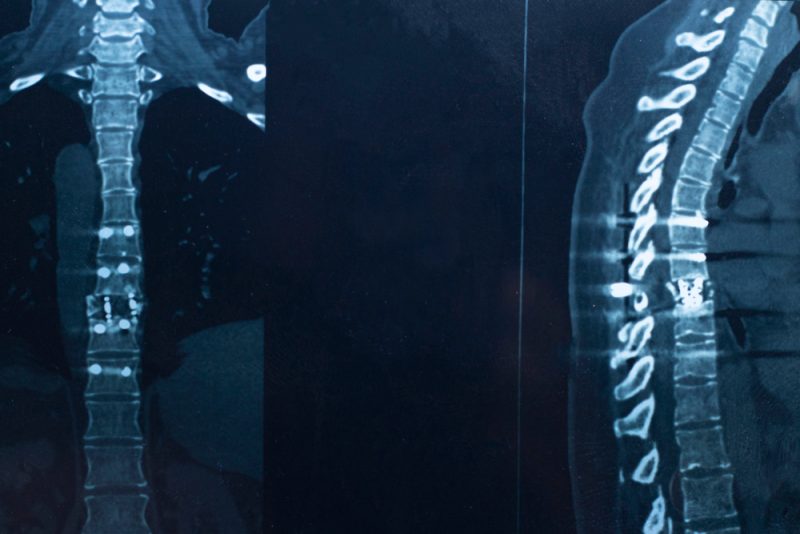 En Allemagne, des thérapies innovantes apportent de l’espoir aux patients atteints du myélome