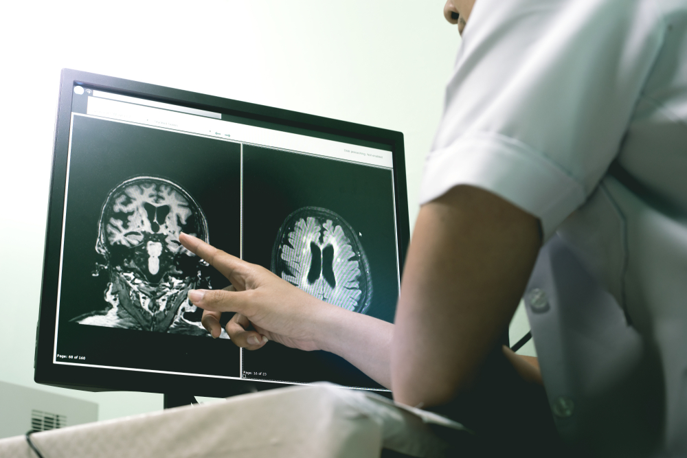 Small,Vessel,Disease,And,Dementia,On,Film,Mri