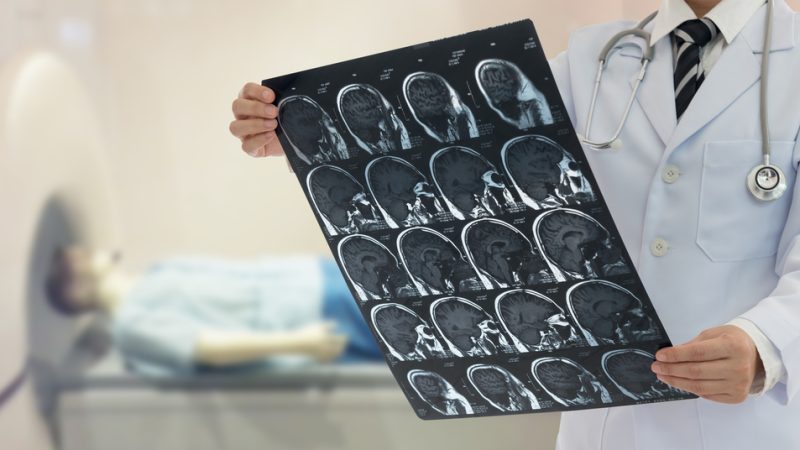Soins post-AVC : dans l’UE, le manque de données freine la prise de mesures