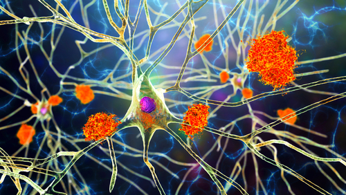L&rsquo;Agence européenne des médicaments rejette un traitement contre Alzheimer
