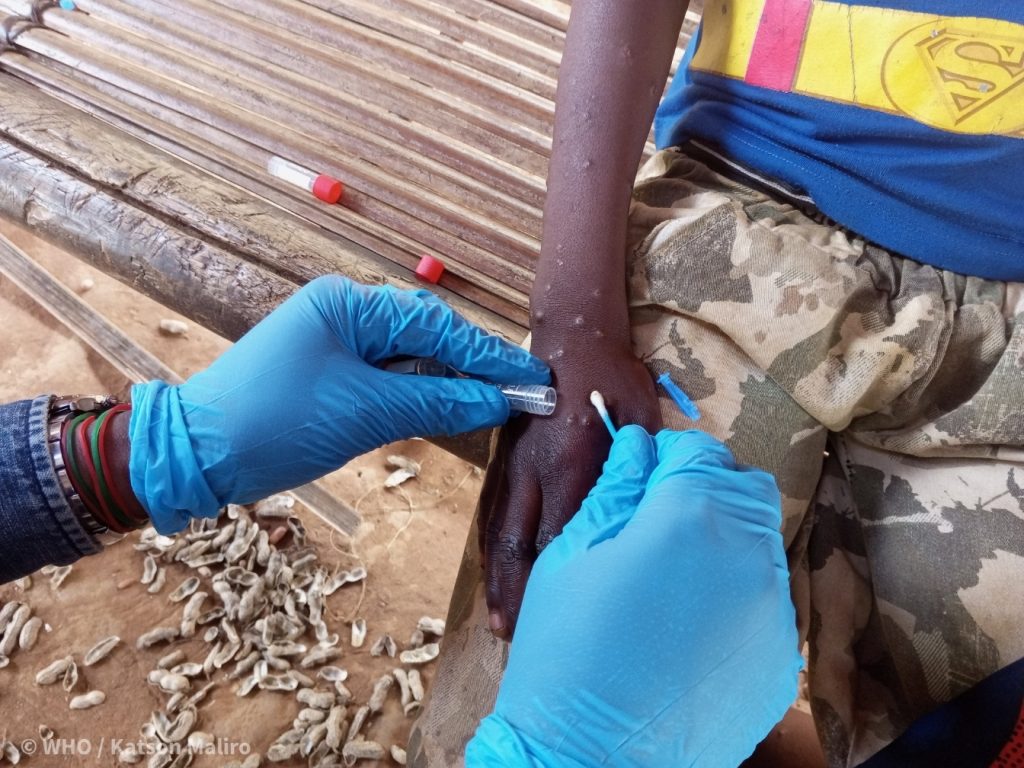 Mpox : l’Agence européenne des médicaments approuve l’utilisation du vaccin pour les adolescents