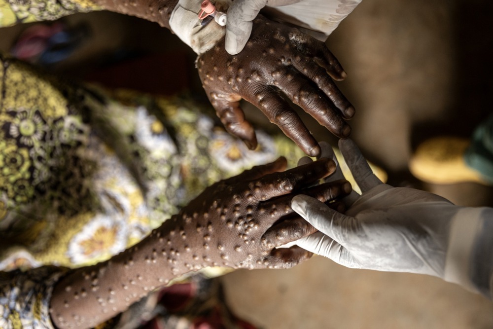 Mpox : la RDC, épicentre de l’épidémie, reçoit ses premiers vaccins