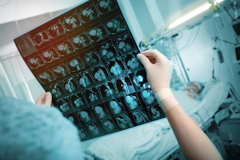 Polen: Kampf gegen metastasierten Brustkrebs ein Wettlauf mit der Zeit