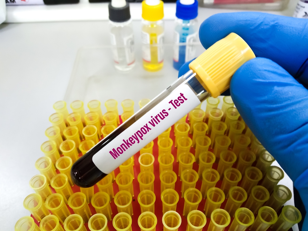 Monkeypox,Infection,Pandemic.,Monkeypox,Infected,Blood,Sample,At,Doctor’s,Hand