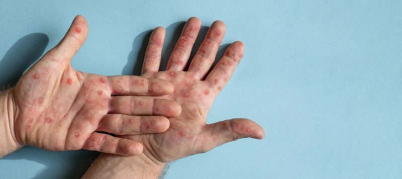 EU-Gesundheitskommissarin: Ernst machen gegen Affenpocken