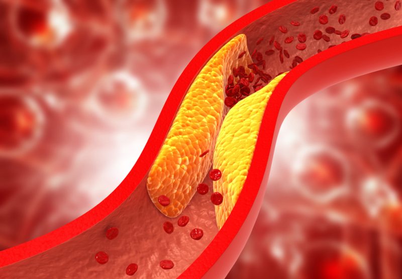 Cholesterin: Vorsorge gegen Fettstoffwechselstörung in Europa lückenhaft