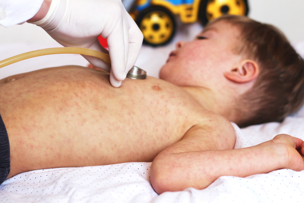 Rumänien ruft Masern-Epidemie aus