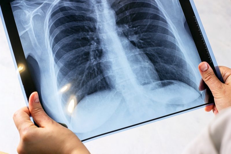 Staaten mit hoher Tuberkulose-Inzidenz setzen auf Ausrottung der Krankheit