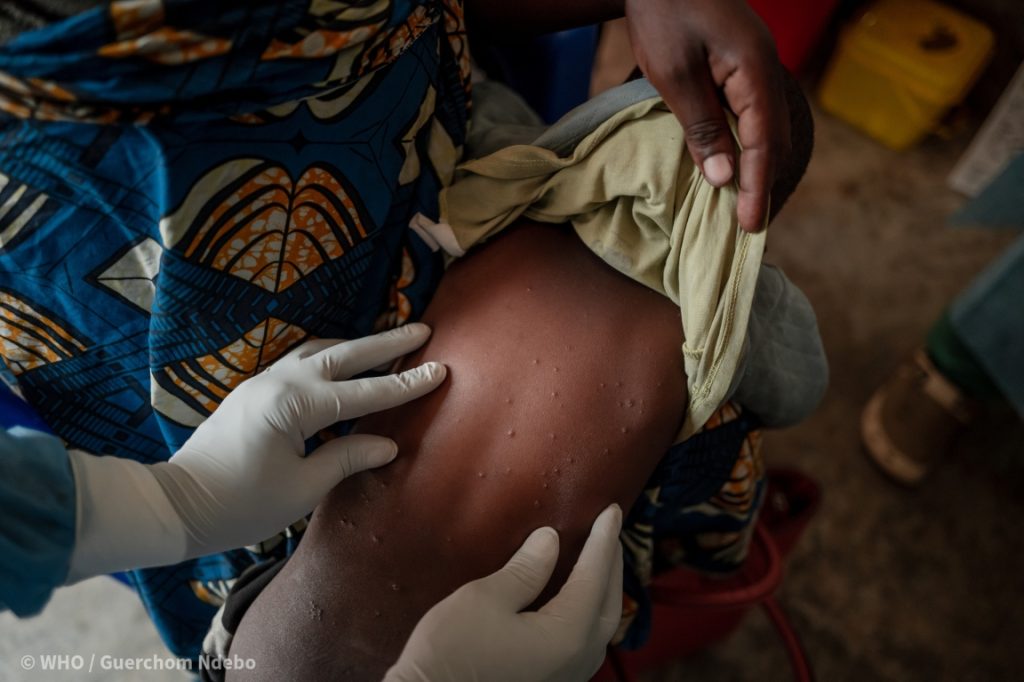 A health worker examines skin lesions that are characteristic of mpox on the back of a young child at the mpox treatment centre at the Nyiragongo General Referral Hospital, north of Goma in the Democratic Republic of the Congo (DRC) on 14 August 2024. On 14 August 2024, WHO Director-General Dr Tedros Adhanom Ghebreyesus determined that the upsurge of mpox in DRC and a growing number of countries in Africa constitutes a public health emergency of international concern (PHEIC) under the International Health Regulations (2005) (IHR). Related: https://www.who.int/news/item/14-08-2024-who-director-general-declares-mpox-outbreak-a-public-health-emergency-of-international-concern